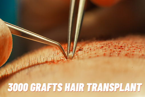 3000 grafts hair transplant